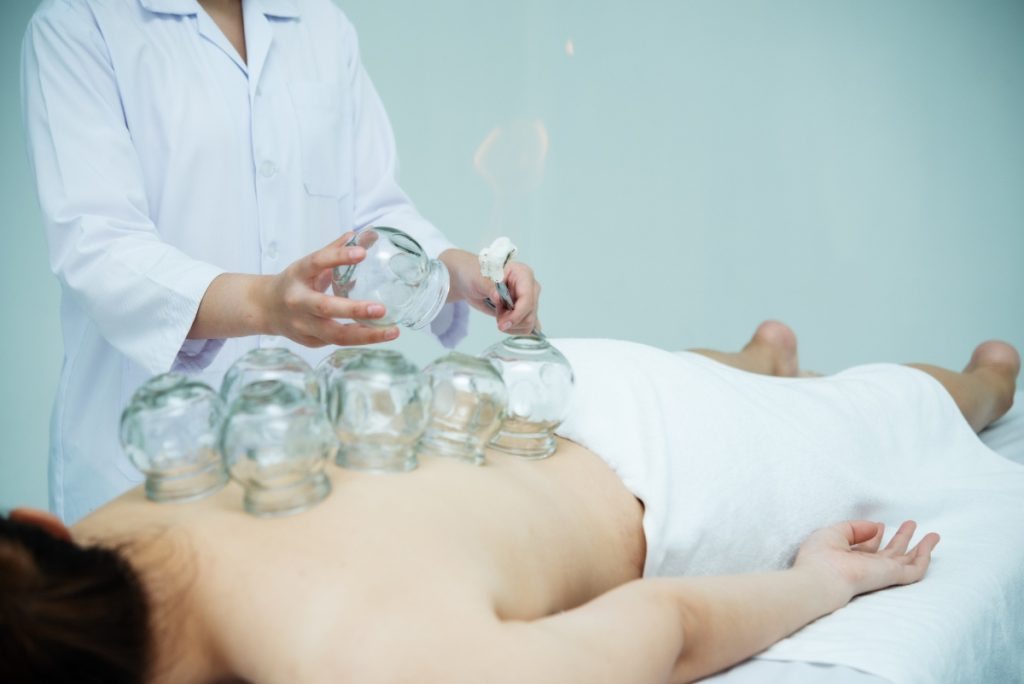 Un thérapeute mettant des ventouses sur le dos d'un patient